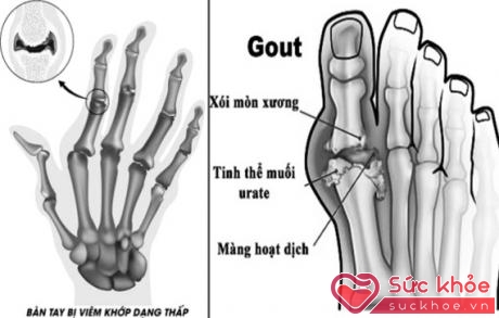 Viêm khớp dạng thấp và bệnh gout dễ mắc trong mùa đông.