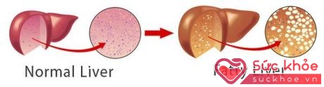 Hình ảnh gan bình thường (trái) và gan nhiễm mỡ (phải). Ảnh minh họa