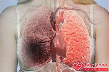 Ung thư phổi gây tràn dịch màng phổi.