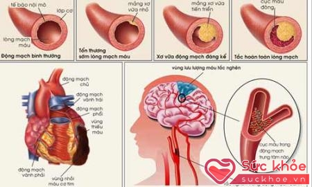 Người bị các về huyết áp và tim mạch, xơ vữa động mạch không nên ăn đậu phụ