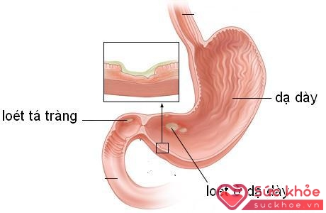 Một số thuốc có tác dụng phụ gây loét dạ dày