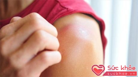  Các thương tổn da thường kèm theo các biểu hiển ngứa, có thể hơi rát bỏng...