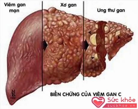 Viêm gan C có thể biến chứng thành xơ gan hoặc ung thư gan