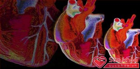  Bệnh tim to hay còn gọi là giãn buồng tim là một bệnh lý nguy hiểm với các triệu chứng thường gặp như đau ngực, khó thở, bất tỉnh hoặc cảm nhận rằng có một cơn đau tim.