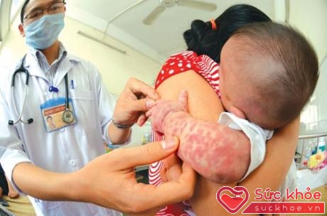 Khi nghi ngờ trẻ bị sốt phát ban cần đưa đến cơ sở y tế để được khám và điều trị