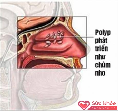 Polyp phát triển như chùm nho cản trở không khí đi qua mũi gây nghẹt mũi