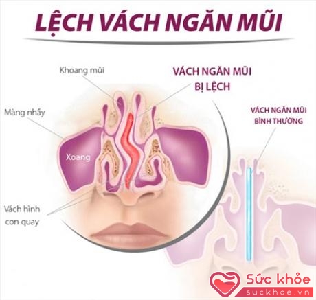 Lệch vách ngăn mũi cũng là nguyên nhân gây nghẹt mũi