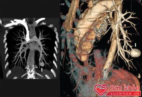   Giãn mạch máu phổi trong hội chứng gan phổi.