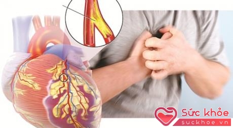 Nhồi máu cơ tim là một biến cố nặng có thể xảy ra với bất cứ ai.