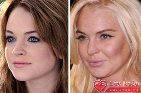 Lindsay Lohan sử dụng chất làm đầy để có bờ môi căng mọng