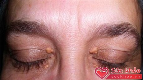 Nam giới trong độ tuổi 70-90 dễ gặp triệu chứng xanthelasma nhất