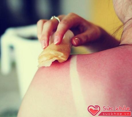 Nhiều người phải đối mặt với tình trạng làn da tổn thương nặng nề vì nắng chói chang mùa hè (Ảnh minh họa: Internet)