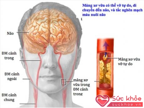 Cơn thoáng thiếu máu não là sự thiếu hụt sự cung cấp máu trong giai đoạn ngắn ở một khu vực nhất định của não bộ