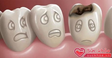 Đánh răng vào buổi tối có thể ngăn ngừa nguy cơ sâu răng
