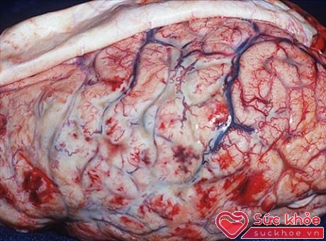 Viêm màng não do mô cầu lây qua đường hô hấp và có thể lây nhiễm qua tiếp xúc với bàn tay, vật dụng cá nhân bị nhiễm vi khuẩn từ bệnh phẩm của bệnh nhân