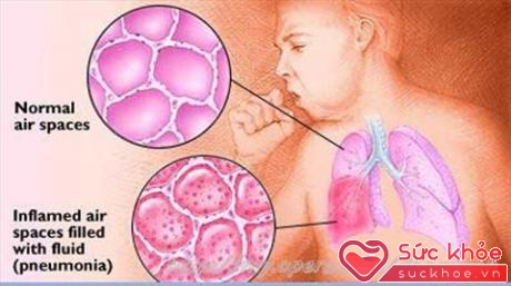 Hình ảnh phổi bình thường và phổi khi bị viêm