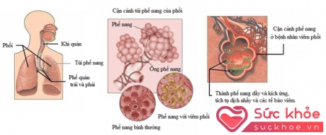 Viêm phổi ở trẻ em