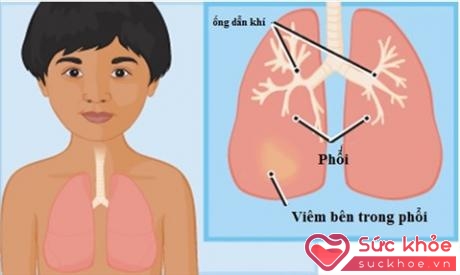 Viêm phổi ở trẻ em nếu không được điều trị kịp thời dễ dẫn đến suy hô hấp và tử vong