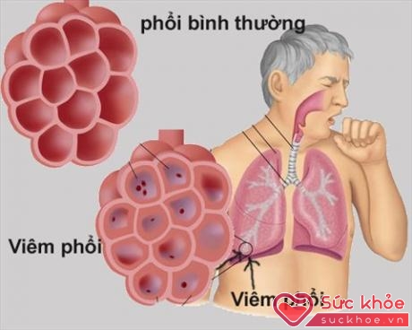 Khó thở và ho liên tục là hiện tượng điển hình của bệnh viêm phổi