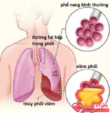 Hình ảnh phế nang bình thường và phế nang bị viêm