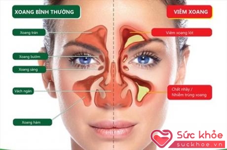 Viêm mũi xoang dị ứng đang có khuynh hướng tăng dần trong mấy năm gần đây