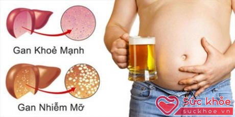 Gan nhiễm mỡ có thể do uống nhiều bia rượu (Ảnh minh họa: Internet)