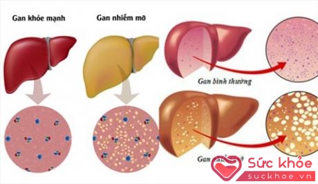So sánh gan nhiễm mỡ và gan khỏe mạnh (Ảnh minh họa: Internet)