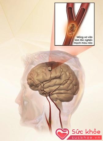 Mảng xơ vữa làm tắc nghẽn mạch máu não gây đột qụy