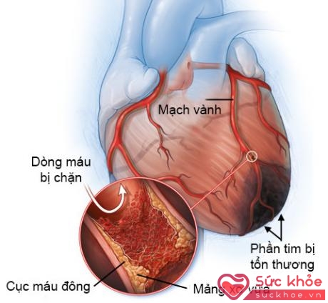 Nhồi máu cơ tim cấp gây tổn thương phần tim không được cấp máu đầy đủ.