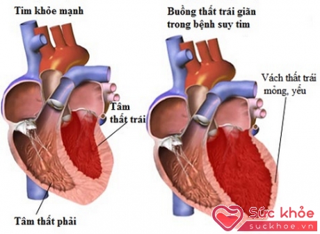 Suy thất trái là biến chứng quan trọng của nhồi máu cơ tim.