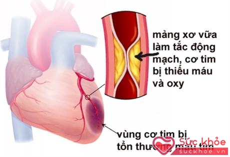 Xơ vữa động mạch là nguyên nhân hàng đầu gây nhồi máu cơ tim, tai biến mạch máu não