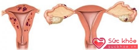 Phân biệt bệnh cơ tuyến tử cung (trái) và lạc nội mạc tử cung (phải).