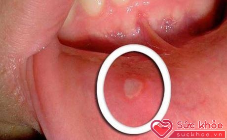 Ung thư hầu-họng thường tập trung ở miệng, lưỡi, vòm miệng và chủ yếu là do các vi rút gây u nhú ở người (HPV) gây ra