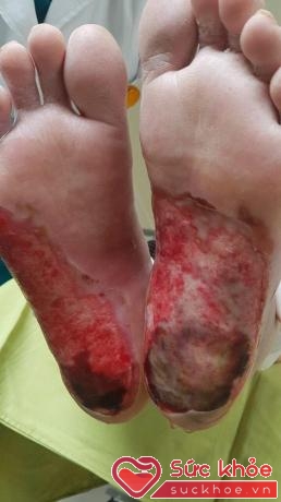 Hai bàn chân bị bỏng nhiệt nặng nề của bệnh nhân P. khi sử dụng đèn sưởi đá muối để chữa tê bì chân tay