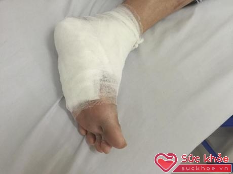 Bàn chân của bệnh nhân P. sau khi được các bác sĩ xử lý vết bỏng sâu do dùng đèn sưởi đá muối