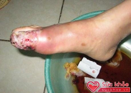Hình ảnh chân bị loét vì đắp thuốc đông y.