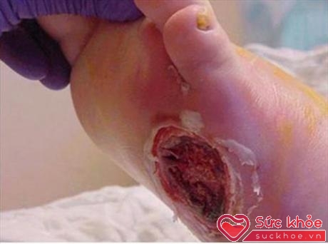 Bàn chân là nơi dễ bị tổn thương nhất khi bị tiểu đường tuýp 2 (Ảnh minh họa: Internet)