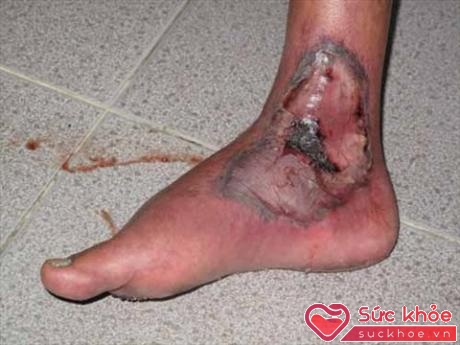 Nhiễm trùng bàn chân ở người bệnh ĐTĐ. Ảnh: TL