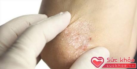 Giữ ẩm cho da là điều cần thiết với bệnh nhân vẩy nến