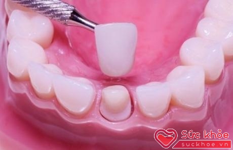 Làm đẹp răng cũng cần đảm bảo an toàn tránh những biến chứng đáng tiếc.