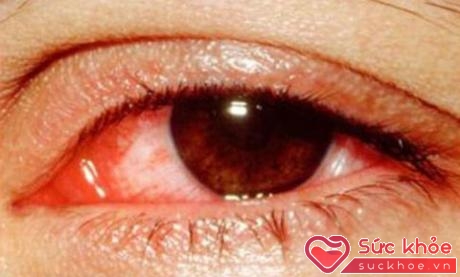 Viêm kết mạc (đau mắt đỏ) do virut nên lây lan rất nhanh. Người bệnh sau khi ngủ dậy, mắt có nhiều dử, đau nhức, sưng nóng