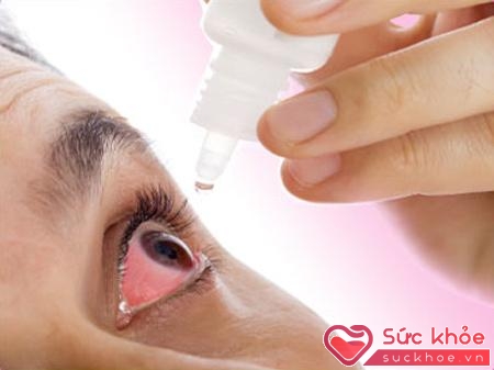 Lạm dụng thuốc nhỏ mắt chứa corticoid kéo dài có thể gây nhiều biến chứng nguy hiểm.