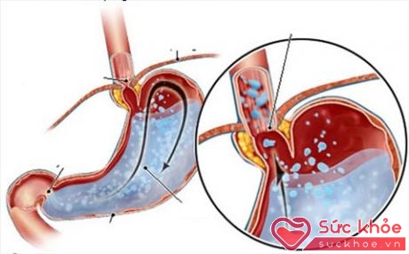 Thuốc điều trị bệnh trào ngược dạ dày - thực quản - ảnh 1