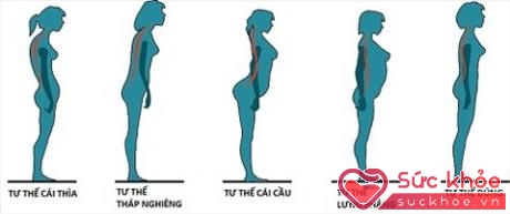 5 tư thế đứng của phái đẹp gây đau lưng (Hình minh họa: BCA)