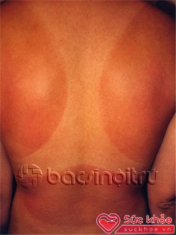 Cháy nắng – Ban đỏ lan tỏa trong khu vực da tiếp xúc với ánh nắng mặt trời xuất hiện ở bệnh nhân bị cháy nắng vùng lưng. Khu vực da được bao phủ bởi quần áo không bị ảnh hưởng.