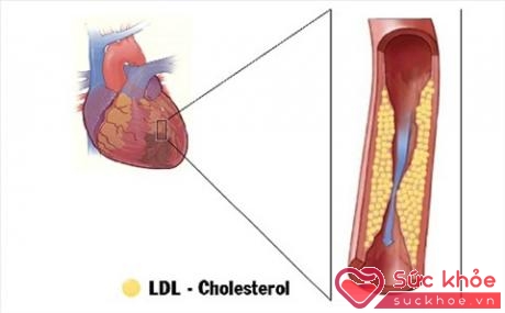 Rối loạn mỡ máu thúc đẩy quá trình xơ vữa động mạch, gây nhồi máu cơ tim
