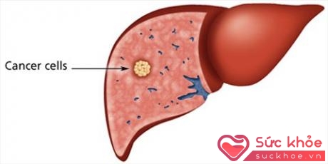 Khối u thường âm thầm phát triển và khi các triệu chứng đã xuất hiện rõ rệt