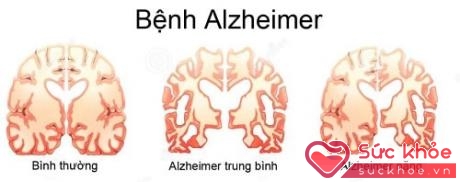 Hình minh họa não của người bình thường và thoái hóa não trên người bệnh Alzheimer.