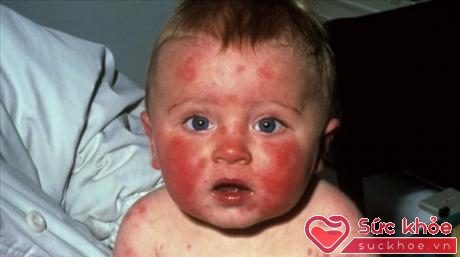 Ban đỏ nhiễm khuẩn khá phổ biến ở trẻ em nhưng lại gây hại cho phụ nữ có thai.