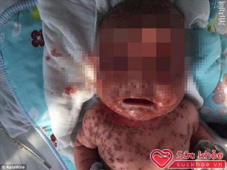 Hình ảnh em bé ba tháng tuổi bị bao phủ bởi các vết phỏng rộp sau khi hôn môi với người mẹ bị nhiễm bệnh.